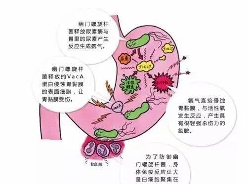 幽门螺杆菌最新治疗方法研究揭秘