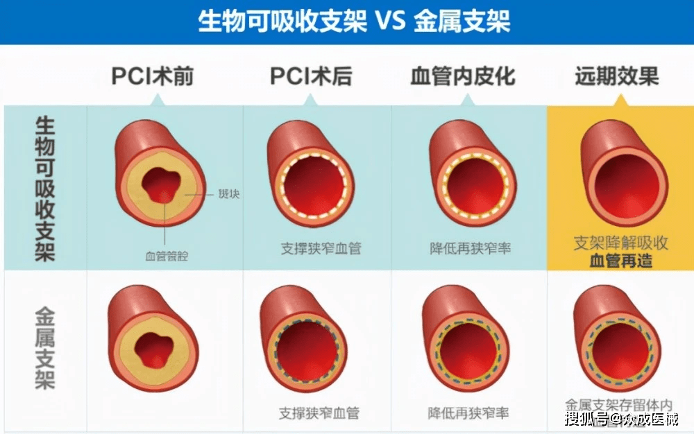 可降解支架最新消息与研究进展综述