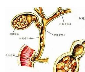 最新胆结石治疗方法概览